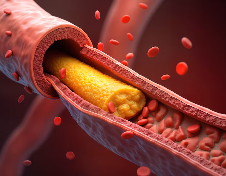 High Cholesterol